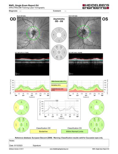 Multiple Evanescent White Dot Syndrome - MEWDS Left Eye
22 year old man with good vision but blind spot in the left eye for a week.  No viral prodrome or vaccination.  VA 20/15 OD, 20/20 OS
