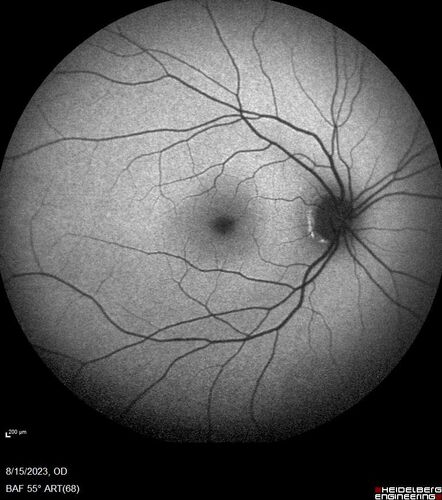Multiple Evanescent White Dot Syndrome - MEWDS Left Eye
22 year old man with good vision but blind spot in the left eye for a week.  No viral prodrome or vaccination.  VA 20/15 OD, 20/20 OS
