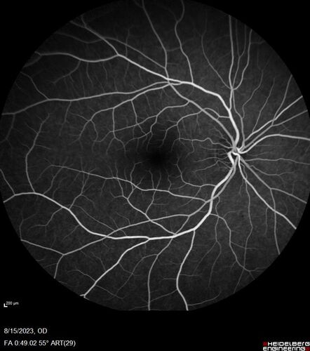 Multiple Evanescent White Dot Syndrome - MEWDS Left Eye
22 year old man with good vision but blind spot in the left eye for a week.  No viral prodrome or vaccination.  VA 20/15 OD, 20/20 OS
