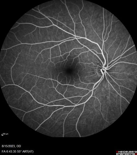 Multiple Evanescent White Dot Syndrome - MEWDS Left Eye
22 year old man with good vision but blind spot in the left eye for a week.  No viral prodrome or vaccination.  VA 20/15 OD, 20/20 OS
