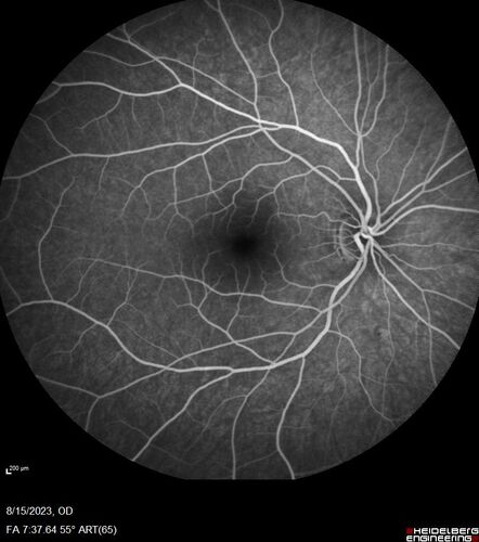 Multiple Evanescent White Dot Syndrome - MEWDS Left Eye
22 year old man with good vision but blind spot in the left eye for a week.  No viral prodrome or vaccination.  VA 20/15 OD, 20/20 OS
