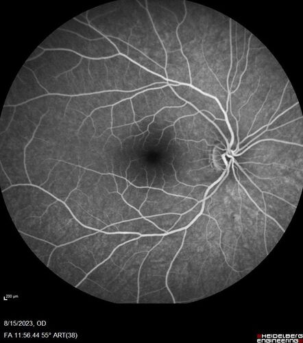 Multiple Evanescent White Dot Syndrome - MEWDS Left Eye
22 year old man with good vision but blind spot in the left eye for a week.  No viral prodrome or vaccination.  VA 20/15 OD, 20/20 OS
