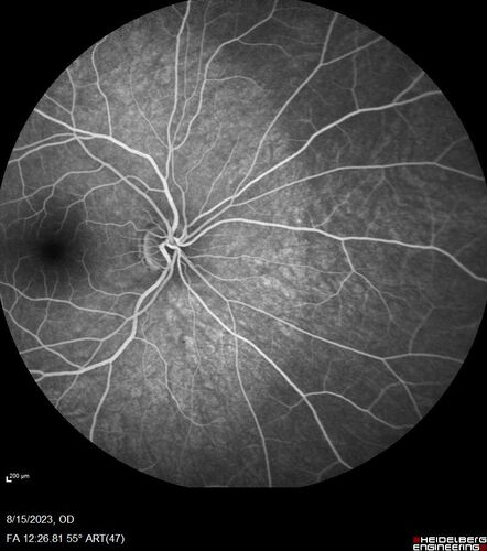 Multiple Evanescent White Dot Syndrome - MEWDS Left Eye
22 year old man with good vision but blind spot in the left eye for a week.  No viral prodrome or vaccination.  VA 20/15 OD, 20/20 OS
