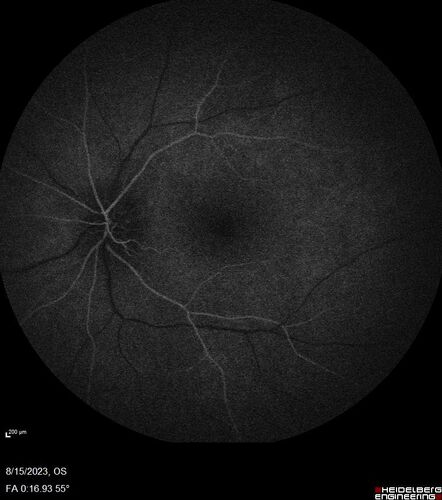 Multiple Evanescent White Dot Syndrome - MEWDS Left Eye
22 year old man with good vision but blind spot in the left eye for a week.  No viral prodrome or vaccination.  VA 20/15 OD, 20/20 OS
