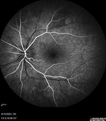 Multiple Evanescent White Dot Syndrome - MEWDS Left Eye
22 year old man with good vision but blind spot in the left eye for a week.  No viral prodrome or vaccination.  VA 20/15 OD, 20/20 OS
