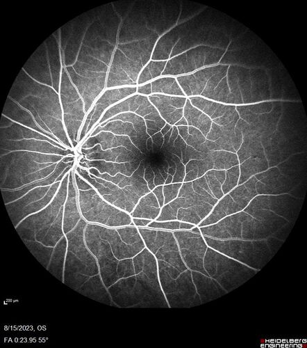 Multiple Evanescent White Dot Syndrome - MEWDS Left Eye
22 year old man with good vision but blind spot in the left eye for a week.  No viral prodrome or vaccination.  VA 20/15 OD, 20/20 OS
