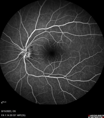 Multiple Evanescent White Dot Syndrome - MEWDS Left Eye
22 year old man with good vision but blind spot in the left eye for a week.  No viral prodrome or vaccination.  VA 20/15 OD, 20/20 OS
