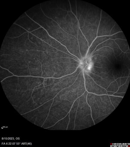Multiple Evanescent White Dot Syndrome - MEWDS Left Eye
22 year old man with good vision but blind spot in the left eye for a week.  No viral prodrome or vaccination.  VA 20/15 OD, 20/20 OS
