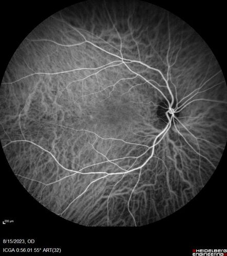 Multiple Evanescent White Dot Syndrome - MEWDS Left Eye
22 year old man with good vision but blind spot in the left eye for a week.  No viral prodrome or vaccination.  VA 20/15 OD, 20/20 OS
