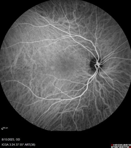 Multiple Evanescent White Dot Syndrome - MEWDS Left Eye
22 year old man with good vision but blind spot in the left eye for a week.  No viral prodrome or vaccination.  VA 20/15 OD, 20/20 OS
