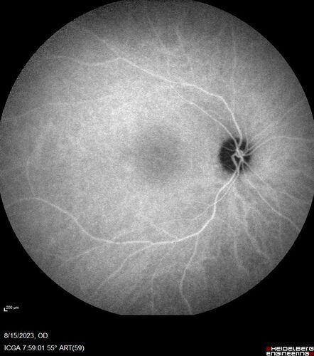 Multiple Evanescent White Dot Syndrome - MEWDS Left Eye
22 year old man with good vision but blind spot in the left eye for a week.  No viral prodrome or vaccination.  VA 20/15 OD, 20/20 OS
