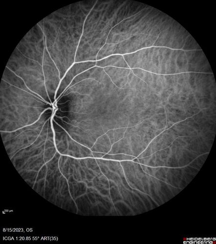 Multiple Evanescent White Dot Syndrome - MEWDS Left Eye
22 year old man with good vision but blind spot in the left eye for a week.  No viral prodrome or vaccination.  VA 20/15 OD, 20/20 OS
