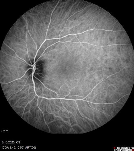 Multiple Evanescent White Dot Syndrome - MEWDS Left Eye
22 year old man with good vision but blind spot in the left eye for a week.  No viral prodrome or vaccination.  VA 20/15 OD, 20/20 OS
