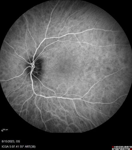 Multiple Evanescent White Dot Syndrome - MEWDS Left Eye
22 year old man with good vision but blind spot in the left eye for a week.  No viral prodrome or vaccination.  VA 20/15 OD, 20/20 OS
