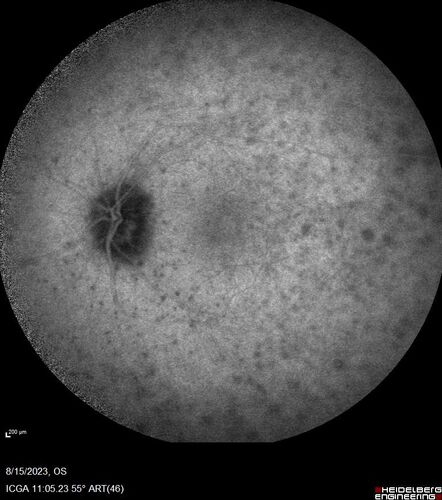 Multiple Evanescent White Dot Syndrome - MEWDS Left Eye
22 year old man with good vision but blind spot in the left eye for a week.  No viral prodrome or vaccination.  VA 20/15 OD, 20/20 OS
