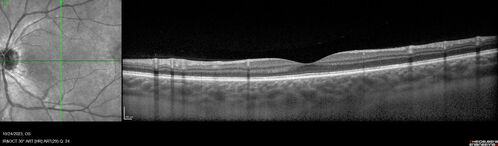 MEWDS - 6 weeks later - Vision 20/16 
Symptoms have almost completely abated.
