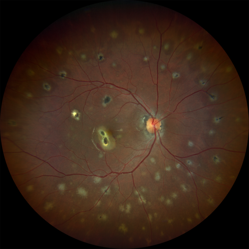 Multifocal Choroiditis and Subretinal Fibrosis with new Subretinal Neovascular Membrane
26 year old African American Girl Saw me at age 10 (16 years ago) with acute multifocal choroiditis and panuveitis which evolved into subretinal fibrosis. She was initially treated with 3 years of methotrexate. Vision ended up 20/20 in both eyes. Her eyes have been inactive since and she was lost to follow-up. 
 A week ago she noticed sudden decreased vision in the right eye.  Within the past few weeks there are more floaters in the right eye.  
VA OD: sc6â€™/200 PHNI
VA OS: sc20/16
