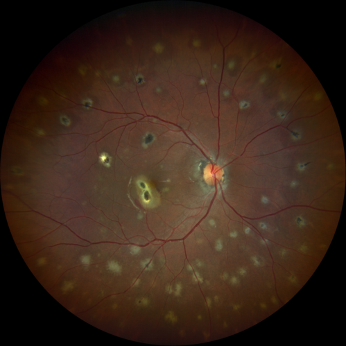 Multifocal Choroiditis and Subretinal Fibrosis with new Subretinal Neovascular Membrane
26 year old African American Girl Saw me at age 10 (16 years ago) with acute multifocal choroiditis and panuveitis which evolved into subretinal fibrosis. She was initially treated with 3 years of methotrexate. Vision ended up 20/20 in both eyes. Her eyes have been inactive since and she was lost to follow-up. 
 A week ago she noticed sudden decreased vision in the right eye.  Within the past few weeks there are more floaters in the right eye.  
VA OD: sc6â€™/200 PHNI
VA OS: sc20/16
