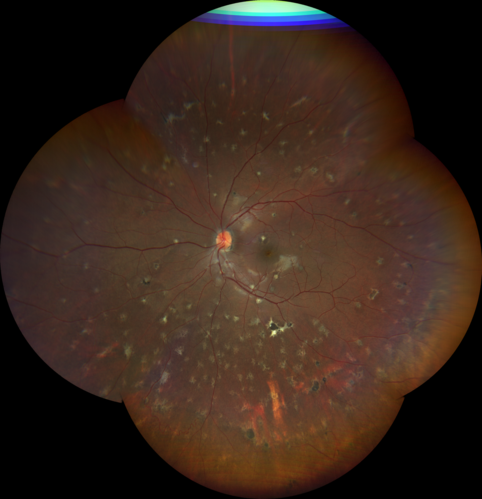 Multifocal Choroiditis and Subretinal Fibrosis with new Subretinal Neovascular Membrane
26 year old African American Girl Saw me at age 10 (16 years ago) with acute multifocal choroiditis and panuveitis which evolved into subretinal fibrosis. She was initially treated with 3 years of methotrexate. Vision ended up 20/20 in both eyes. Her eyes have been inactive since and she was lost to follow-up. 
 A week ago she noticed sudden decreased vision in the right eye.  Within the past few weeks there are more floaters in the right eye.  
VA OD: sc6â€™/200 PHNI
VA OS: sc20/16
