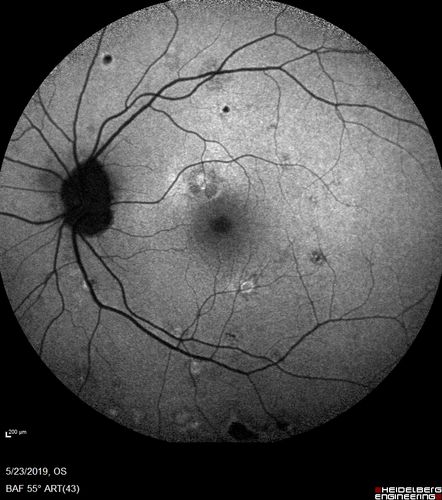Multifocal Choroiditis and Subretinal Fibrosis with new Subretinal Neovascular Membrane
26 year old African American Girl Saw me at age 10 (16 years ago) with acute multifocal choroiditis and panuveitis which evolved into subretinal fibrosis. She was initially treated with 3 years of methotrexate. Vision ended up 20/20 in both eyes. Her eyes have been inactive since and she was lost to follow-up. 
 A week ago she noticed sudden decreased vision in the right eye.  Within the past few weeks there are more floaters in the right eye.  
VA OD: sc6â€™/200 PHNI
VA OS: sc20/16
