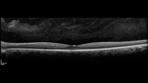 Multifocal Choroiditis and Subretinal Fibrosis with new Subretinal Neovascular Membrane
26 year old African American Girl Saw me at age 10 (16 years ago) with acute multifocal choroiditis and panuveitis which evolved into subretinal fibrosis. She was initially treated with 3 years of methotrexate. Vision ended up 20/20 in both eyes. Her eyes have been inactive since and she was lost to follow-up. 
 A week ago she noticed sudden decreased vision in the right eye.  Within the past few weeks there are more floaters in the right eye.  
VA OD: sc6â€™/200 PHNI
VA OS: sc20/16
