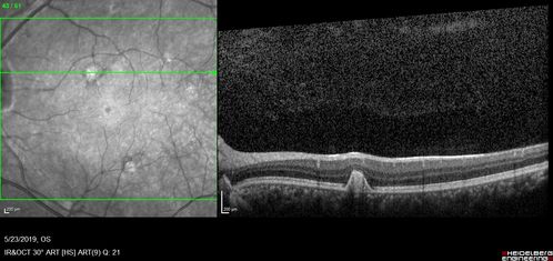 Multifocal Choroiditis and Subretinal Fibrosis with new Subretinal Neovascular Membrane
26 year old African American Girl Saw me at age 10 (16 years ago) with acute multifocal choroiditis and panuveitis which evolved into subretinal fibrosis. She was initially treated with 3 years of methotrexate. Vision ended up 20/20 in both eyes. Her eyes have been inactive since and she was lost to follow-up. 
 A week ago she noticed sudden decreased vision in the right eye.  Within the past few weeks there are more floaters in the right eye.  
VA OD: sc6â€™/200 PHNI
VA OS: sc20/16
