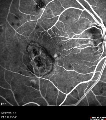 Multifocal Choroiditis and Subretinal Fibrosis with new Subretinal Neovascular Membrane
26 year old African American Girl Saw me at age 10 (16 years ago) with acute multifocal choroiditis and panuveitis which evolved into subretinal fibrosis. She was initially treated with 3 years of methotrexate. Vision ended up 20/20 in both eyes. Her eyes have been inactive since and she was lost to follow-up. 
 A week ago she noticed sudden decreased vision in the right eye.  Within the past few weeks there are more floaters in the right eye.  
VA OD: sc6â€™/200 PHNI
VA OS: sc20/16
