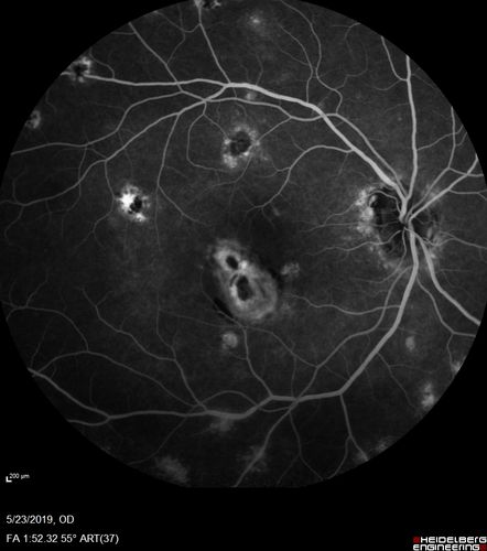 Multifocal Choroiditis and Subretinal Fibrosis with new Subretinal Neovascular Membrane
26 year old African American Girl Saw me at age 10 (16 years ago) with acute multifocal choroiditis and panuveitis which evolved into subretinal fibrosis. She was initially treated with 3 years of methotrexate. Vision ended up 20/20 in both eyes. Her eyes have been inactive since and she was lost to follow-up. 
 A week ago she noticed sudden decreased vision in the right eye.  Within the past few weeks there are more floaters in the right eye.  
VA OD: sc6â€™/200 PHNI
VA OS: sc20/16
