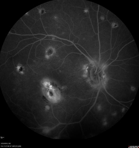 Multifocal Choroiditis and Subretinal Fibrosis with new Subretinal Neovascular Membrane
26 year old African American Girl Saw me at age 10 (16 years ago) with acute multifocal choroiditis and panuveitis which evolved into subretinal fibrosis. She was initially treated with 3 years of methotrexate. Vision ended up 20/20 in both eyes. Her eyes have been inactive since and she was lost to follow-up. 
 A week ago she noticed sudden decreased vision in the right eye.  Within the past few weeks there are more floaters in the right eye.  
VA OD: sc6â€™/200 PHNI
VA OS: sc20/16
