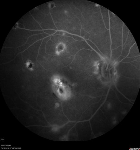 Multifocal Choroiditis and Subretinal Fibrosis with new Subretinal Neovascular Membrane
26 year old African American Girl Saw me at age 10 (16 years ago) with acute multifocal choroiditis and panuveitis which evolved into subretinal fibrosis. She was initially treated with 3 years of methotrexate. Vision ended up 20/20 in both eyes. Her eyes have been inactive since and she was lost to follow-up. 
 A week ago she noticed sudden decreased vision in the right eye.  Within the past few weeks there are more floaters in the right eye.  
VA OD: sc6â€™/200 PHNI
VA OS: sc20/16
