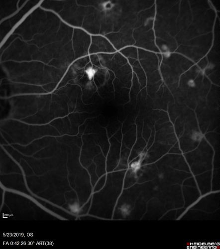 Multifocal Choroiditis and Subretinal Fibrosis with new Subretinal Neovascular Membrane
26 year old African American Girl Saw me at age 10 (16 years ago) with acute multifocal choroiditis and panuveitis which evolved into subretinal fibrosis. She was initially treated with 3 years of methotrexate. Vision ended up 20/20 in both eyes. Her eyes have been inactive since and she was lost to follow-up. 
 A week ago she noticed sudden decreased vision in the right eye.  Within the past few weeks there are more floaters in the right eye.  
VA OD: sc6â€™/200 PHNI
VA OS: sc20/16
