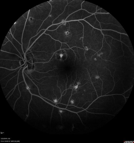 Multifocal Choroiditis and Subretinal Fibrosis with new Subretinal Neovascular Membrane
26 year old African American Girl Saw me at age 10 (16 years ago) with acute multifocal choroiditis and panuveitis which evolved into subretinal fibrosis. She was initially treated with 3 years of methotrexate. Vision ended up 20/20 in both eyes. Her eyes have been inactive since and she was lost to follow-up. 
 A week ago she noticed sudden decreased vision in the right eye.  Within the past few weeks there are more floaters in the right eye.  
VA OD: sc6â€™/200 PHNI
VA OS: sc20/16
