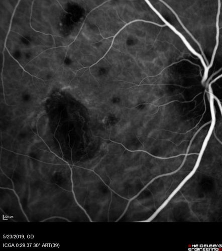 Multifocal Choroiditis and Subretinal Fibrosis with new Subretinal Neovascular Membrane
26 year old African American Girl Saw me at age 10 (16 years ago) with acute multifocal choroiditis and panuveitis which evolved into subretinal fibrosis. She was initially treated with 3 years of methotrexate. Vision ended up 20/20 in both eyes. Her eyes have been inactive since and she was lost to follow-up. 
 A week ago she noticed sudden decreased vision in the right eye.  Within the past few weeks there are more floaters in the right eye.  
VA OD: sc6â€™/200 PHNI
VA OS: sc20/16
