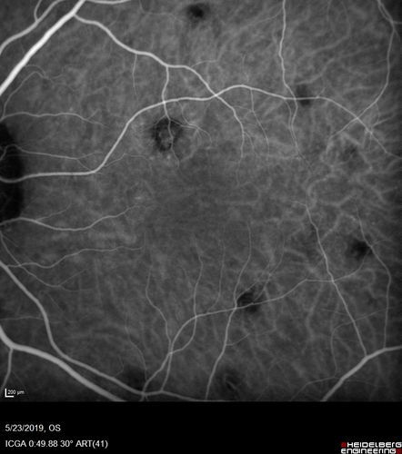 Multifocal Choroiditis and Subretinal Fibrosis with new Subretinal Neovascular Membrane
26 year old African American Girl Saw me at age 10 (16 years ago) with acute multifocal choroiditis and panuveitis which evolved into subretinal fibrosis. She was initially treated with 3 years of methotrexate. Vision ended up 20/20 in both eyes. Her eyes have been inactive since and she was lost to follow-up. 
 A week ago she noticed sudden decreased vision in the right eye.  Within the past few weeks there are more floaters in the right eye.  
VA OD: sc6â€™/200 PHNI
VA OS: sc20/16
