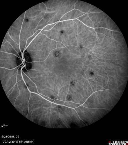 Multifocal Choroiditis and Subretinal Fibrosis with new Subretinal Neovascular Membrane
26 year old African American Girl Saw me at age 10 (16 years ago) with acute multifocal choroiditis and panuveitis which evolved into subretinal fibrosis. She was initially treated with 3 years of methotrexate. Vision ended up 20/20 in both eyes. Her eyes have been inactive since and she was lost to follow-up. 
 A week ago she noticed sudden decreased vision in the right eye.  Within the past few weeks there are more floaters in the right eye.  
VA OD: sc6â€™/200 PHNI
VA OS: sc20/16
