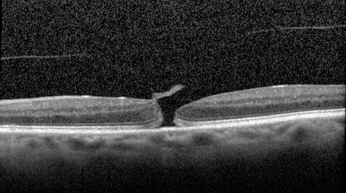 Stage II Macular Hole - PPV without ILM peel
77 year old man with 20/40 VA on presentation.  Macular hole did not abort and vision dropped to 20/63.  Post PPV vision was 20/25 within 6 months
