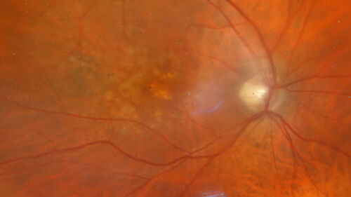 Conversion to Wet AMD after Izervay
83 year  old  man whose  left eye had minimal GA and converted from dry to wet AMD after a single Izervay treatment
