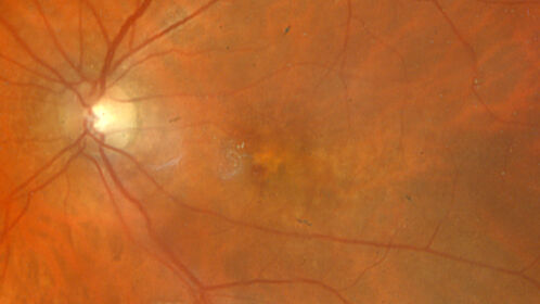 Conversion to Wet AMD after Izervay
83 year  old  man whose  left eye had minimal GA and converted from dry to wet AMD after a single Izervay treatment
