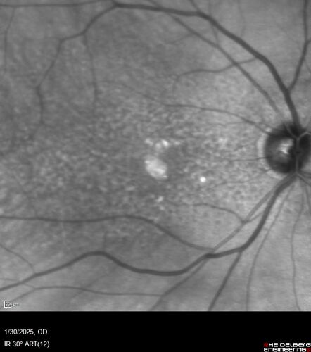 Conversion to Wet AMD after Izervay
83 year  old  man whose  left eye had minimal GA and converted from dry to wet AMD after a single Izervay treatment
