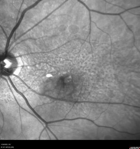 Conversion to Wet AMD after Izervay
83 year  old  man whose  left eye had minimal GA and converted from dry to wet AMD after a single Izervay treatment
