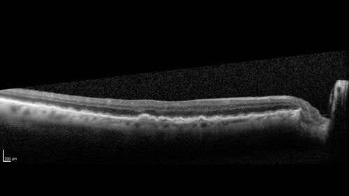 Conversion to Wet AMD after Izervay
83 year  old  man whose  left eye had minimal GA and converted from dry to wet AMD after a single Izervay treatment
