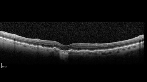Conversion to Wet AMD after Izervay
83 year  old  man whose  left eye had minimal GA and converted from dry to wet AMD after a single Izervay treatment

