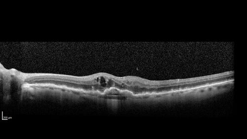Conversion to Wet AMD after Izervay
83 year  old  man whose  left eye had minimal GA and converted from dry to wet AMD after a single Izervay treatment
