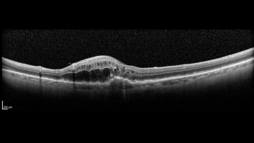 Conversion to Wet AMD after Izervay
83 year  old  man whose  left eye had minimal GA and converted from dry to wet AMD after a single Izervay treatment
