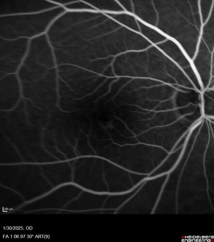 Conversion to Wet AMD after Izervay
83 year  old  man whose  left eye had minimal GA and converted from dry to wet AMD after a single Izervay treatment
