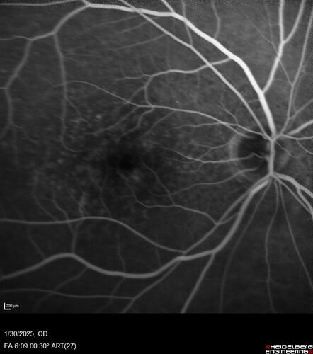 Conversion to Wet AMD after Izervay
83 year  old  man whose  left eye had minimal GA and converted from dry to wet AMD after a single Izervay treatment
