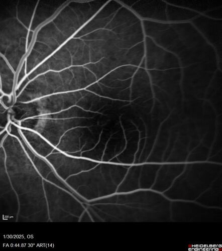 Conversion to Wet AMD after Izervay
83 year  old  man whose  left eye had minimal GA and converted from dry to wet AMD after a single Izervay treatment
