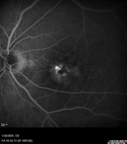 Conversion to Wet AMD after Izervay
83 year  old  man whose  left eye had minimal GA and converted from dry to wet AMD after a single Izervay treatment
