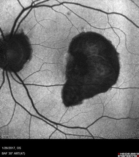 Macular Scars - Laser (1980s) Ocular Histoplasmosis
70 year old man who had laser at Wills, Wilmer and the Mayo clinic before better therapies were available for ocular histoplasmosis related CNVM
