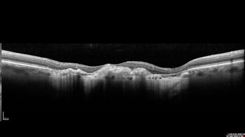 Macular Scars - Laser (1980s) Ocular Histoplasmosis
70 year old man who had laser at Wills, Wilmer and the Mayo clinic before better therapies were available for ocular histoplasmosis related CNVM
